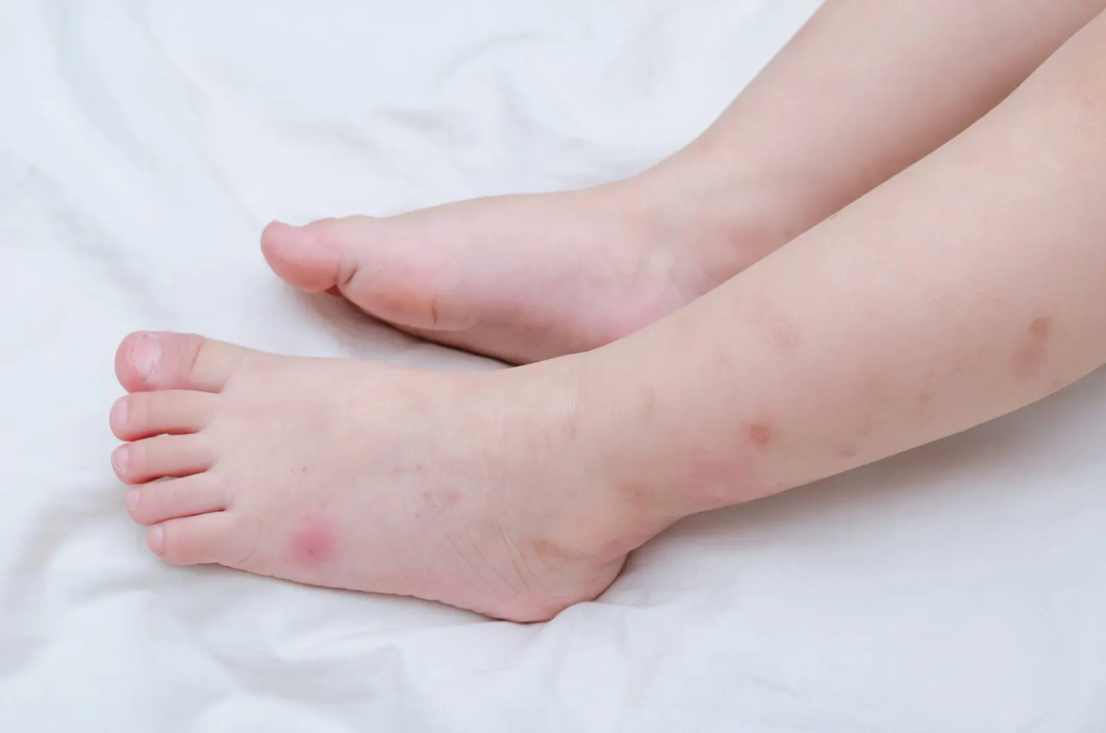 Bed Bug bites on kid's legs