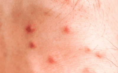 Fleas in the Midwest: What St. Louis Renters and Homeowners Need to Know